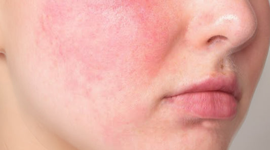 Rosacea, The Mysterious Skin Condition