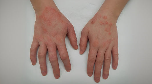 A Vaccine on the Horizon, Could Eczema Be Eradicated Soon?